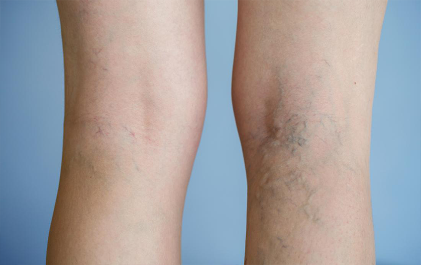 Early Stage Varicose Veins Symptoms